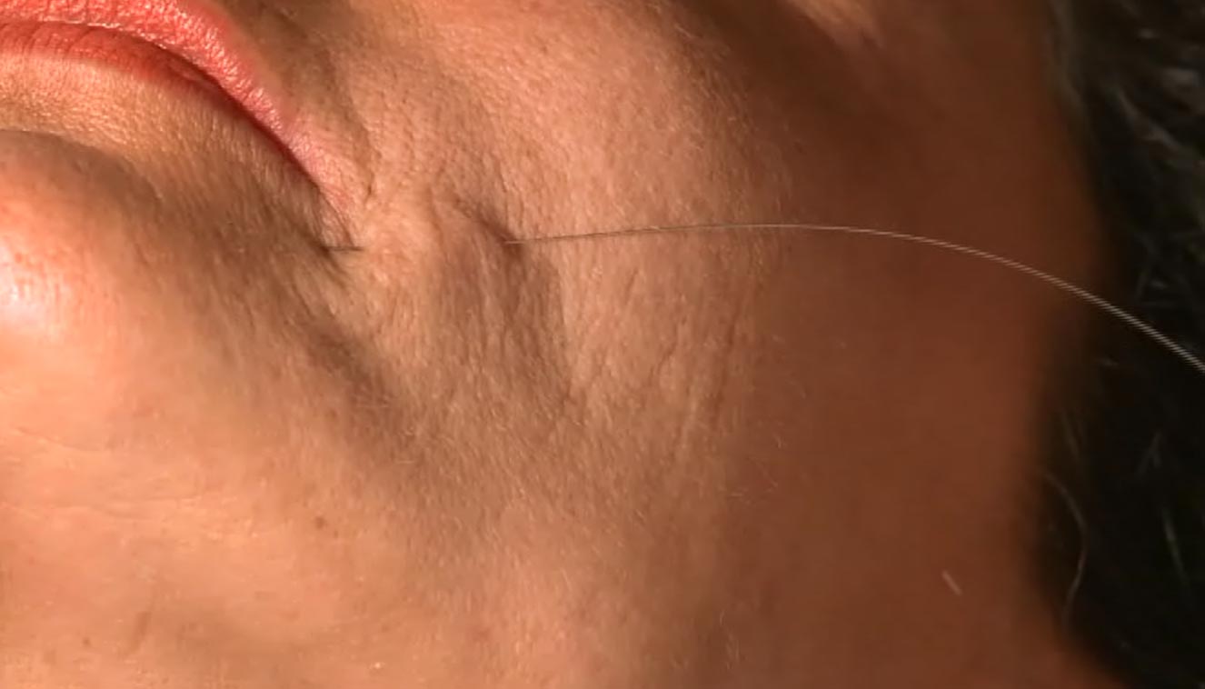 chirurgia non ablativa - medicina estetica, chirurgia non ablativa, rimozione tatuaggi, filler, rughe, acido ialuronico, botulino