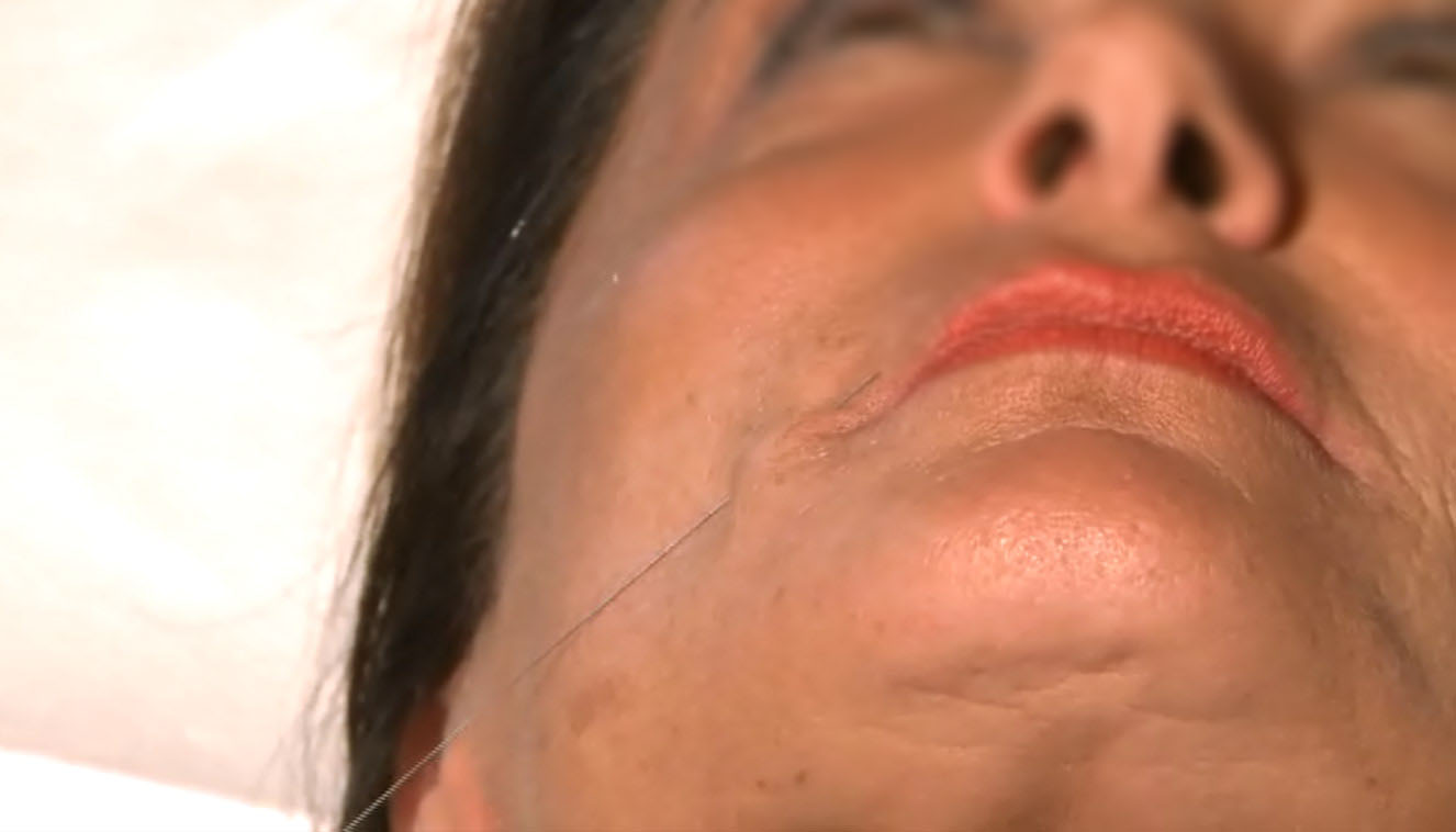 needle shaping - medicina estetica, chirurgia non ablativa, rimozione tatuaggi, filler, rughe, acido ialuronico, botulino