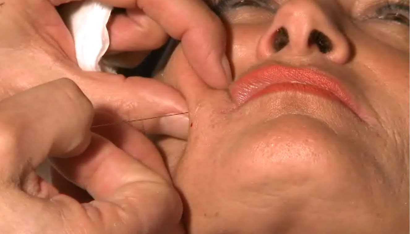 needle shaping - medicina estetica, chirurgia non ablativa, rimozione tatuaggi, filler, rughe, acido ialuronico, botulino