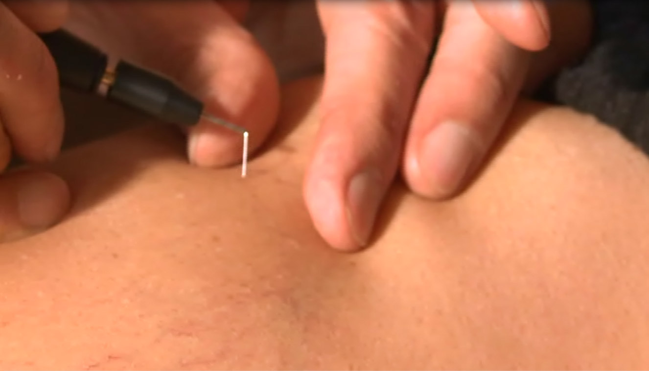 off - medicina estetica, chirurgia non ablativa, rimozione tatuaggi, filler, rughe, acido ialuronico, botulino