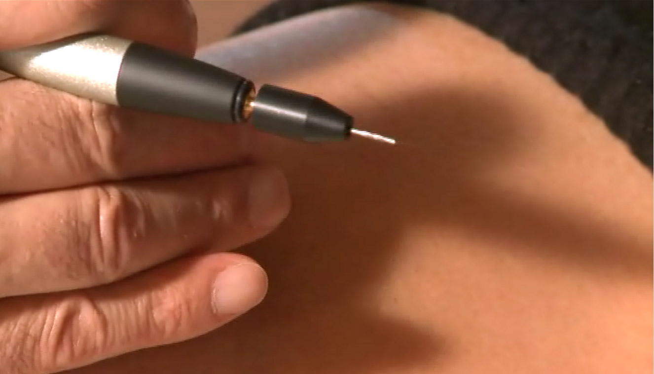 off - medicina estetica, chirurgia non ablativa, rimozione tatuaggi, filler, rughe, acido ialuronico, botulino