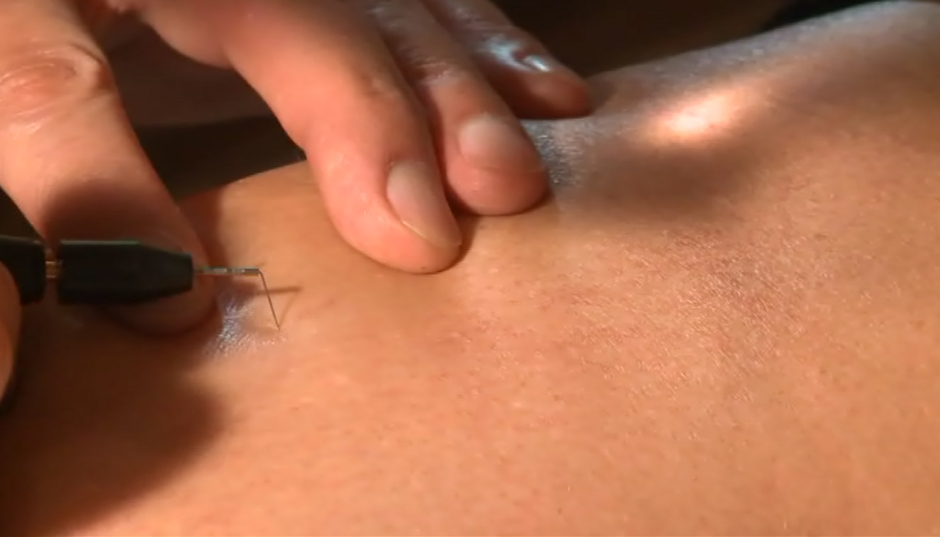 off - medicina estetica, chirurgia non ablativa, rimozione tatuaggi, filler, rughe, acido ialuronico, botulino