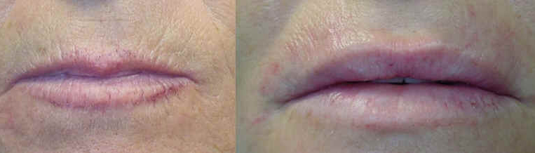 medicina estetica, chirurgia non ablativa, rimozione tatuaggi, filler, rughe, acido ialuronico, botulino