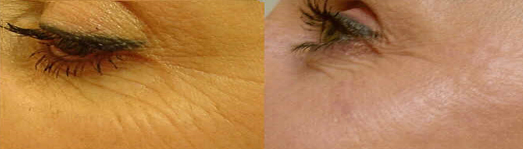 medicina estetica, chirurgia non ablativa, rimozione tatuaggi, filler, rughe, acido ialuronico, botulino