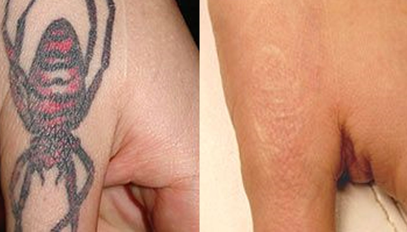 chirurgia non ablativa - medicina estetica, chirurgia non ablativa, rimozione tatuaggi, filler, rughe, acido ialuronico, botulino
