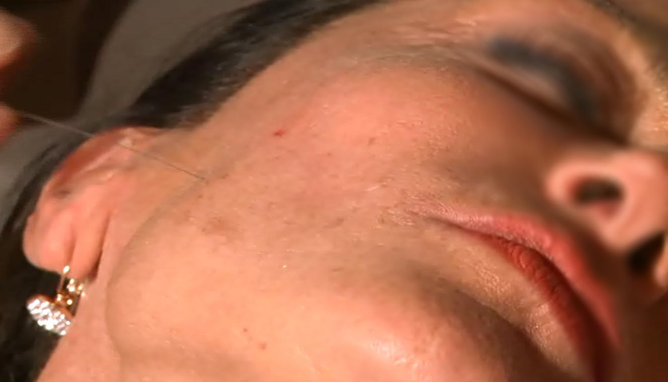 chirurgia non ablativa - medicina estetica, chirurgia non ablativa, rimozione tatuaggi, filler, rughe, acido ialuronico, botulino