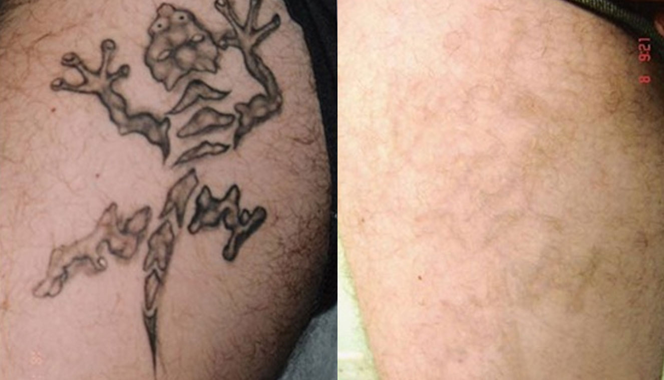 rimozione tatuaggi - medicina estetica, chirurgia non ablativa, rimozione tatuaggi, filler, rughe, acido ialuronico, botulino