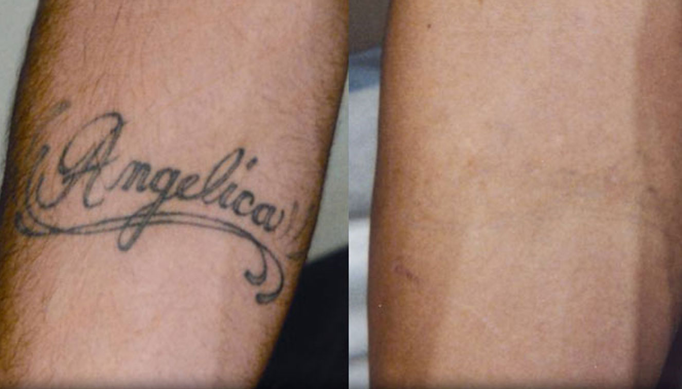 rimozione tatuaggi - medicina estetica, chirurgia non ablativa, rimozione tatuaggi, filler, rughe, acido ialuronico, botulino
