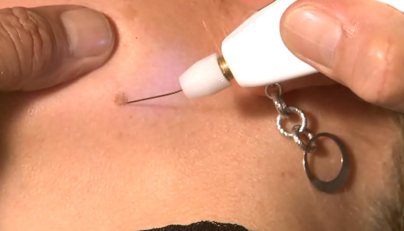 chirurgia non ablativa - medicina estetica, chirurgia non ablativa, rimozione tatuaggi, filler, rughe, acido ialuronico, botulino