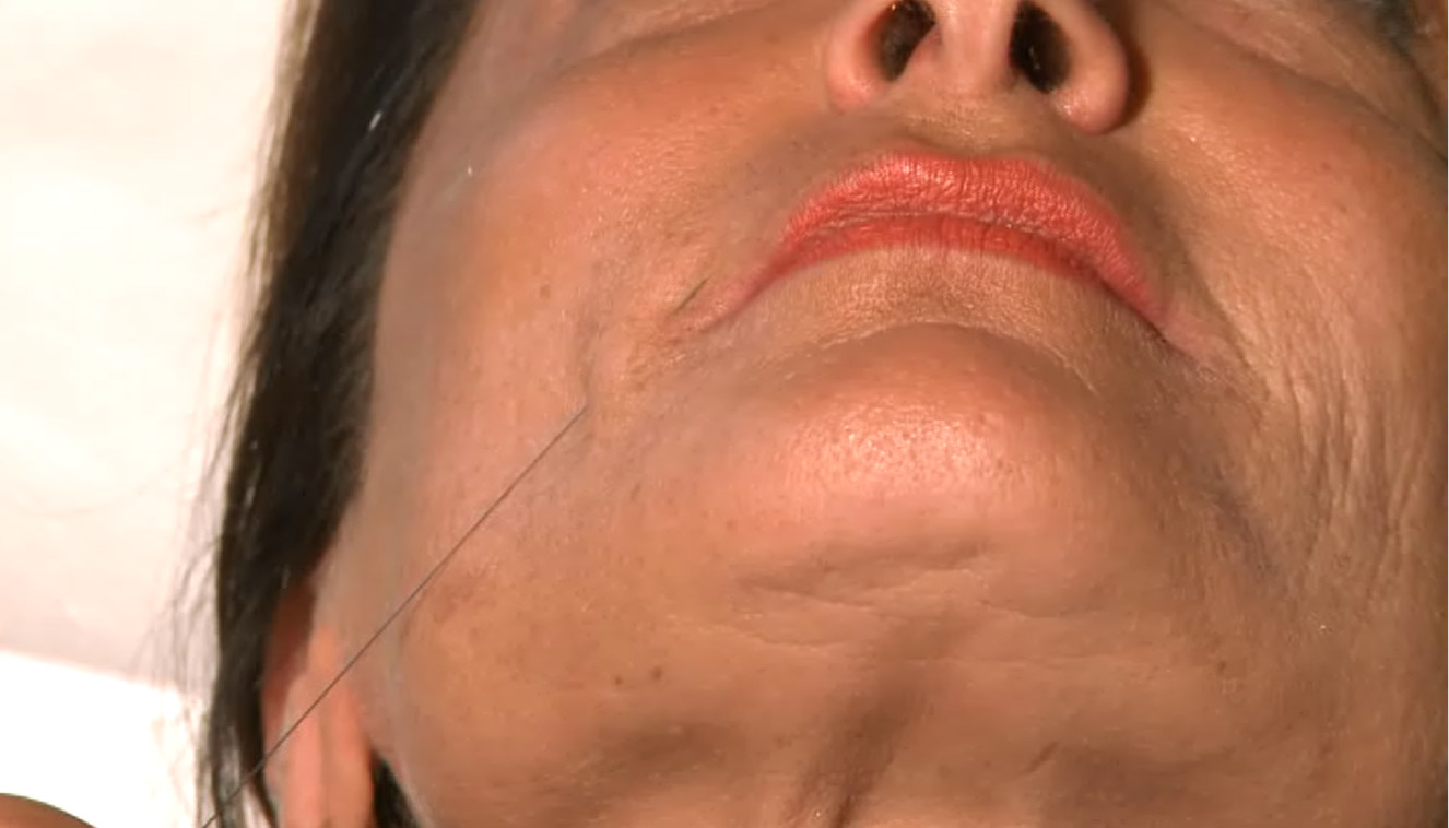 needle shaping - medicina estetica, chirurgia non ablativa, rimozione tatuaggi, filler, rughe, acido ialuronico, botulino
